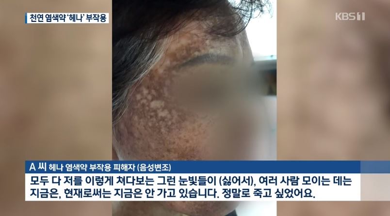 헤나 염색 부작용 속출, 얼굴까지 검게 변색..천연재료지만 화학성분도 포함돼