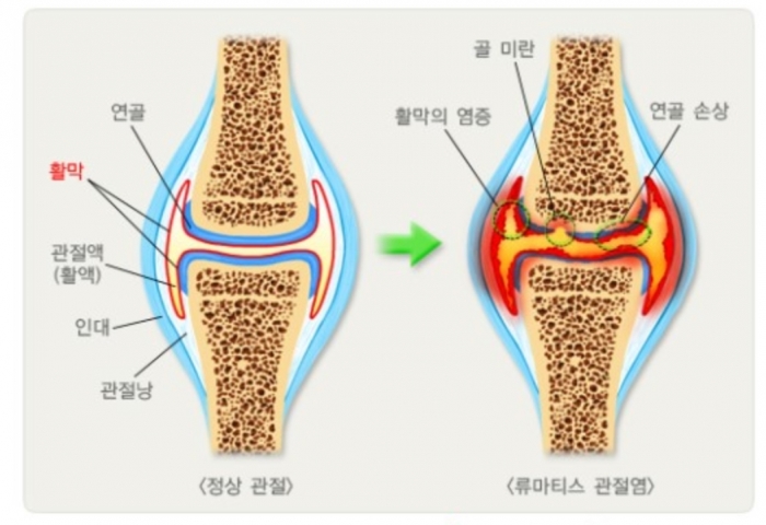 류마티스 관절염 환자 76%는 여성...여름철에 진료환자 증가