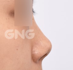 [좌담] 코질환 ⑦짧은코(들창코)·휜코, 첫 수술과 재수술의 다른 점은?