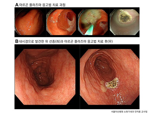 1cm 미만 위 선종, 내시경으로 안 떼는 방법도 있다
