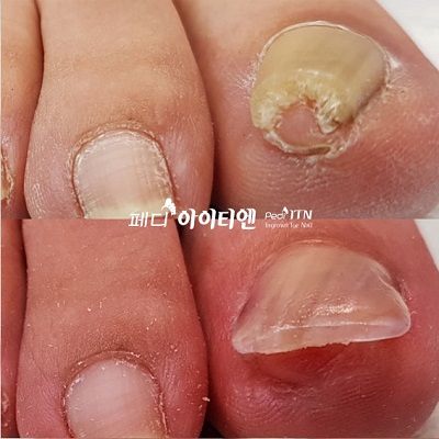 내향성 파고드는 발톱, 이젠 페디아이티엔으로 관리 해결
