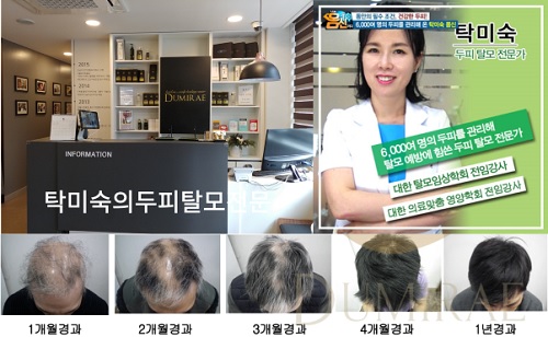 두미래, 한국인에 딱 맞는 탈모치료 및 예방법 선보여