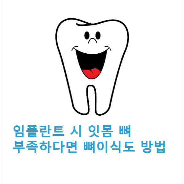 [카드뉴스] 임플란트 시 잇몸 뼈 부족하다면 뼈이식도 방법