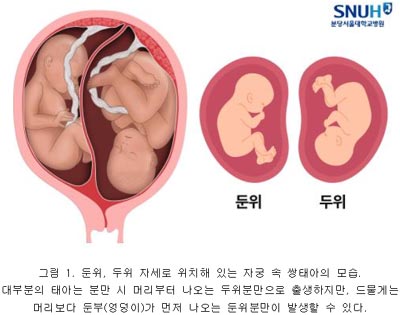 거꾸로 태어난 아이, 발달성 고관절 이형성증 강력한 위험인자 작용