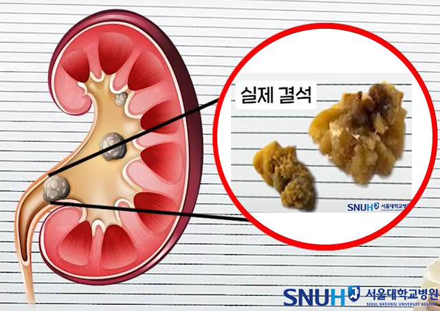 여름철 ‘요로결석’ 주의…수분 섭취 줄어들면 발생률 증가