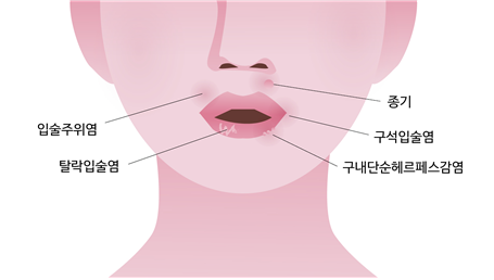 입 주위 발진·뾰루지, 피로가 아닌 세균 감염 때문? 