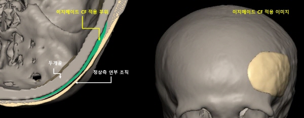 시지바이오, 3D 임플란트 이지메이드-CF 두개골 수술 성공