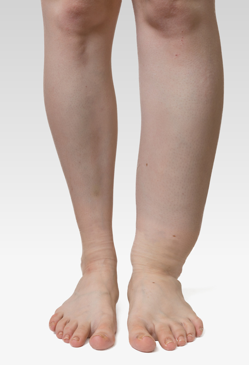 코끼리처럼 퉁퉁 부은 다리…하지림프부종이란
