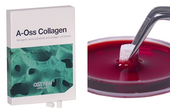 오스템임플란트 ‘A-Oss Collagen’ 인기