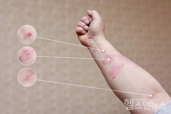 하얀 각질, 붉은 반점... 겨울철 내 피부 왜 이래
