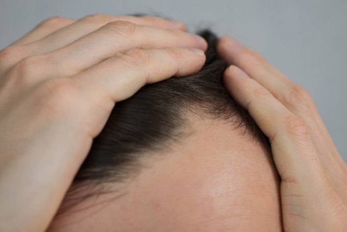 머리 자주 감으면 탈모 생긴다?…속설의 거짓과 진실