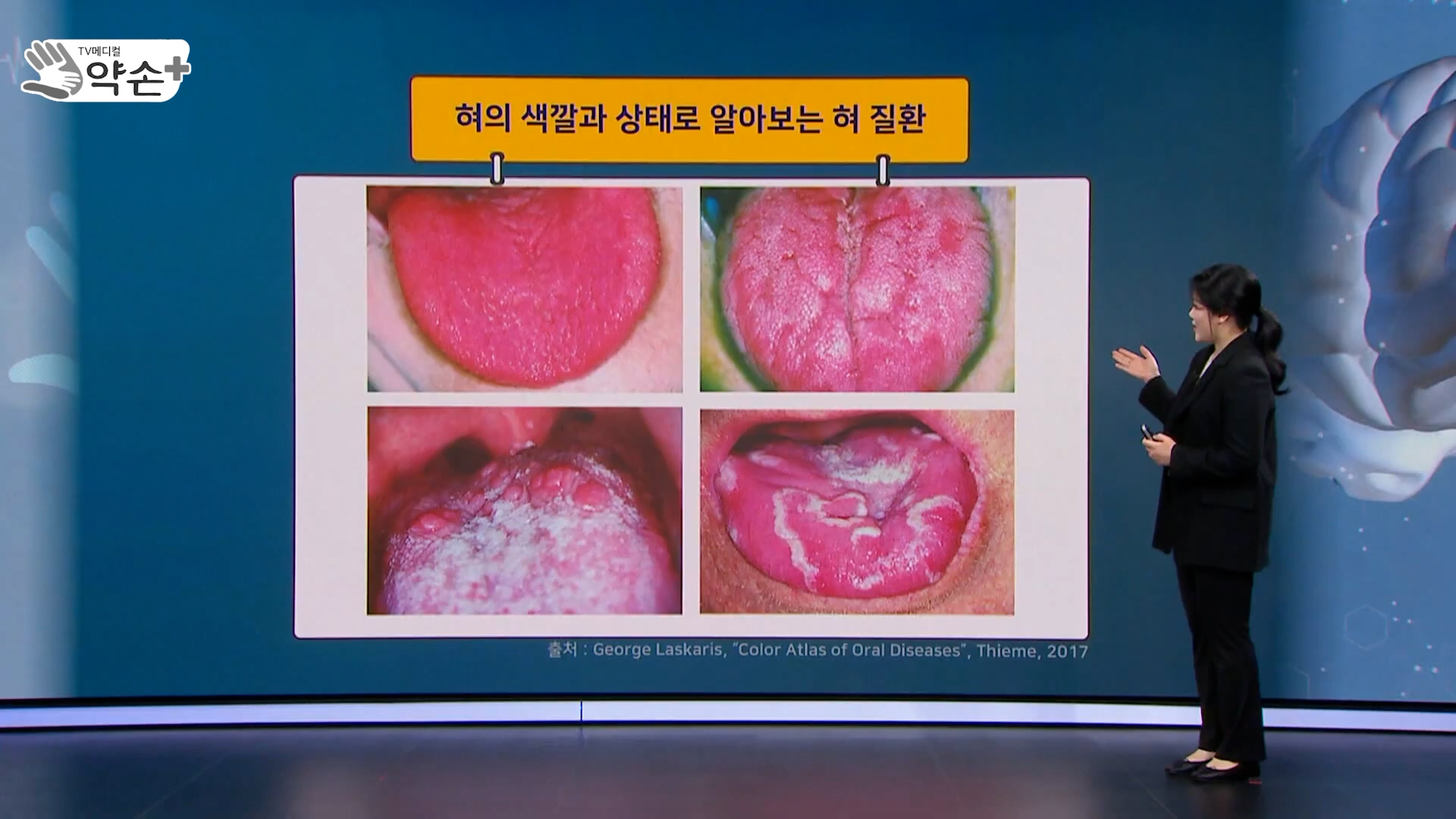 [약손+] 내 몸이 보내는 건강 신호 ‘혀 질환’ ④혀의 정상 변이-치흔·설균열