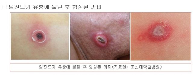 쯔쯔가무시 치료 기간
