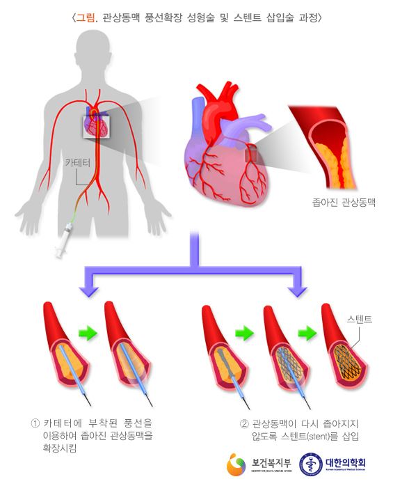 심근경색 원인과 예방법